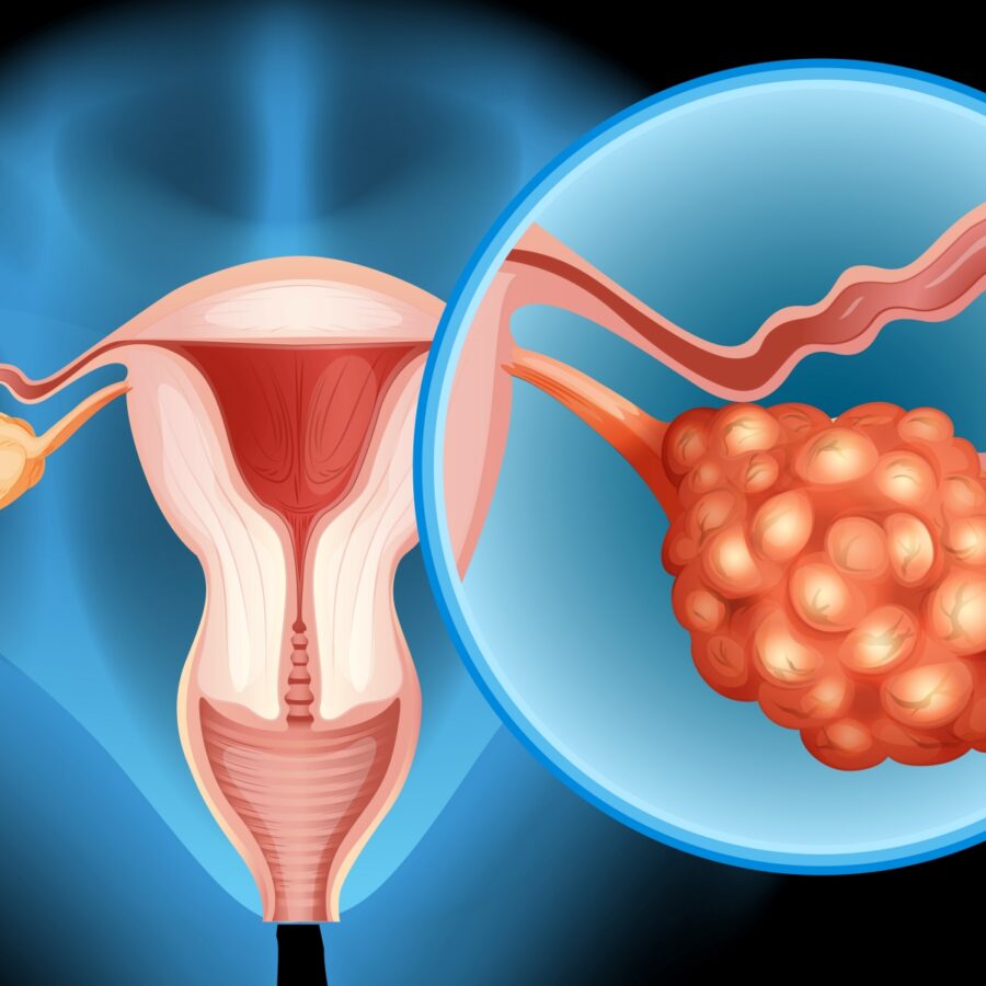 PCOS ve İnfertilite