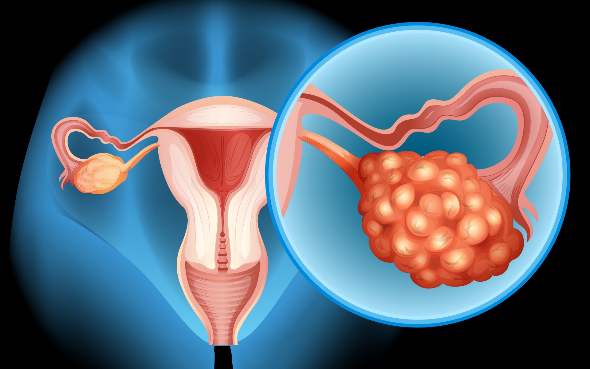 PCOS ve İnfertilite